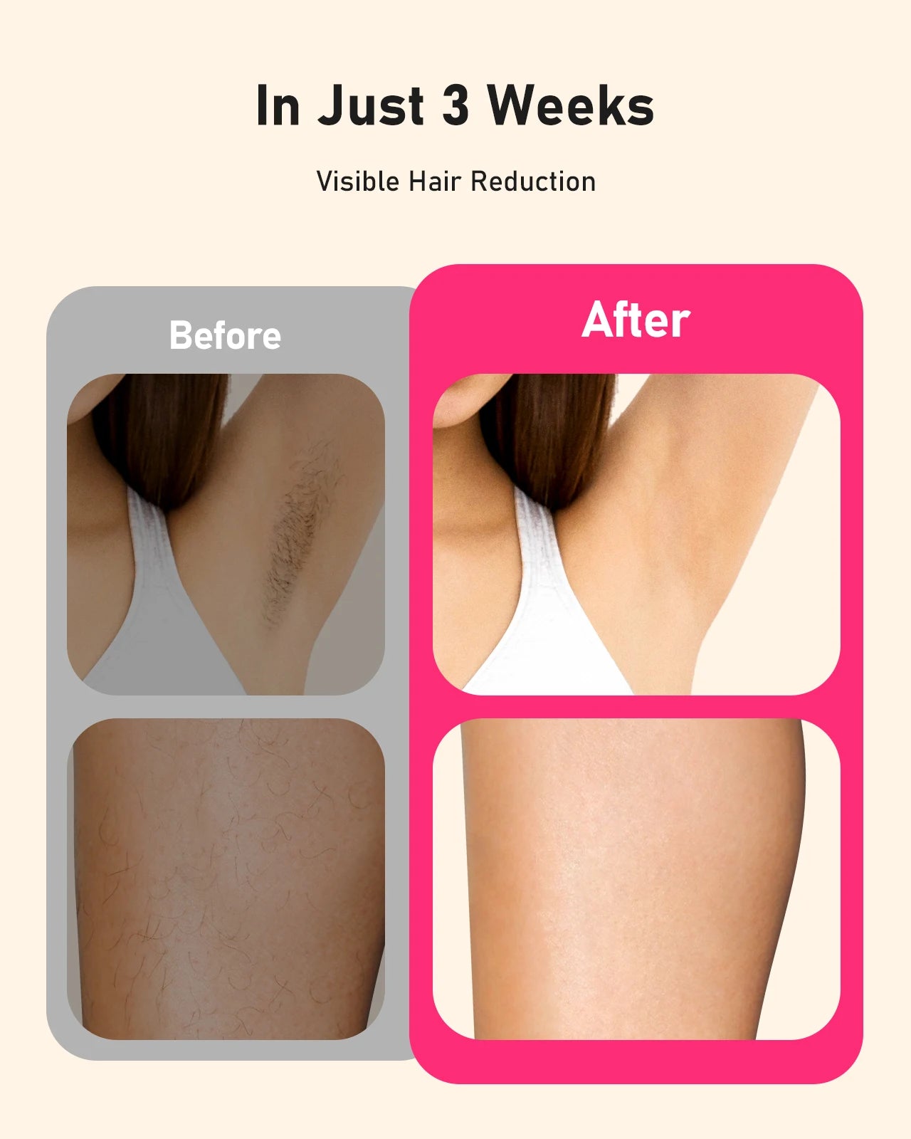 Laser Hair Removal Device for Smooth, Permanent Skin at Home